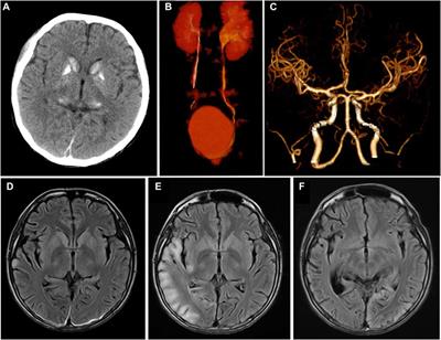 Fahr’s syndrome as the initial imaging characteristics of MELAS syndrome with a possible seizure activity and cardiac arrest: a case report